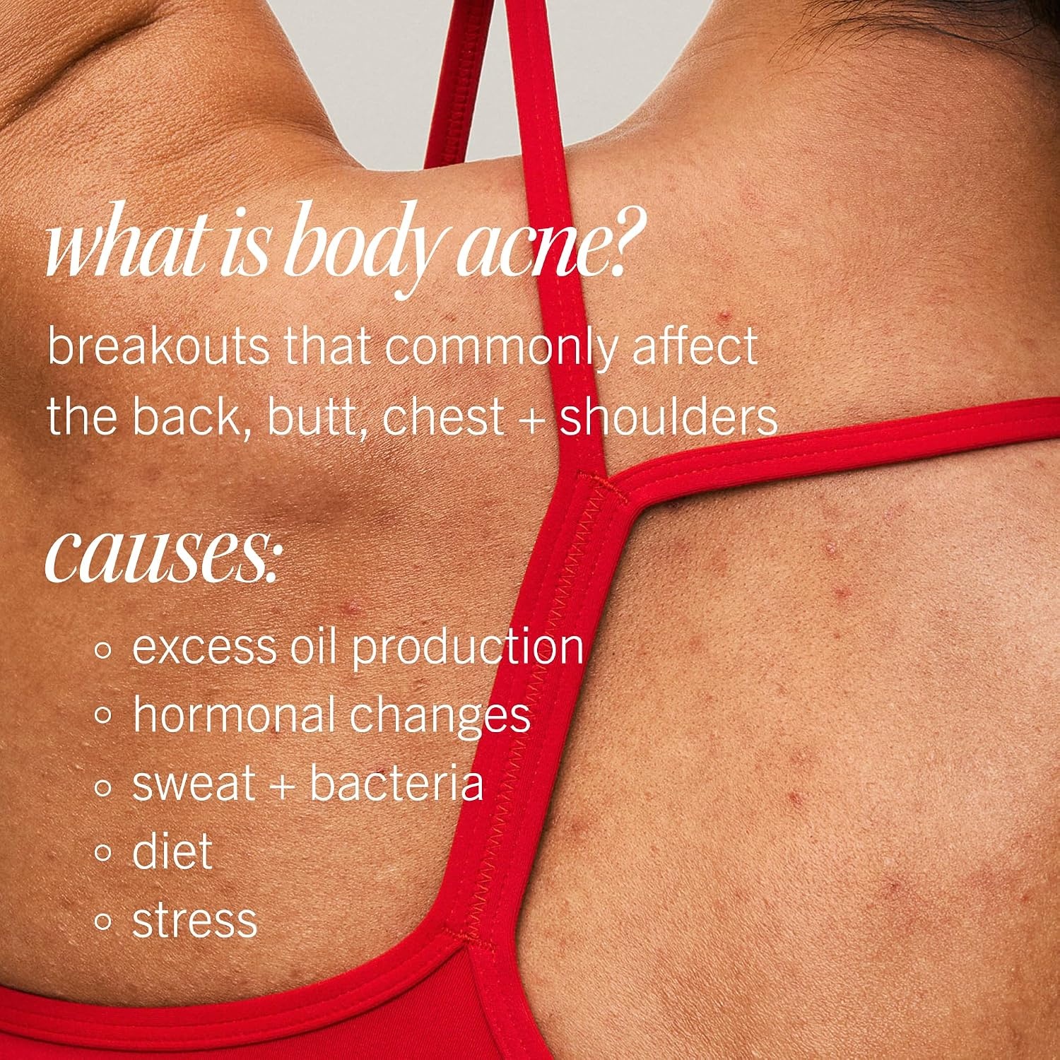 image:imageFirst Aid Beauty Body Acne SprayUnscented