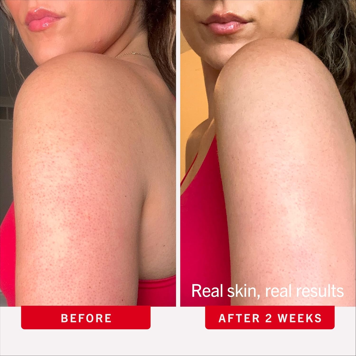 image:imageFirst Aid Beauty KP Bump Eraser Body Scrub with 10 AHA DermatologistTested Keratosis Pilaris Exfoliator Support for Rough Bumps Uneven Skin Texture amp Strawberry Skin Sensitive Skin8 Ounce Pack of 1