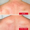 First Aid Beauty Body Acne Spray(Unscented)
